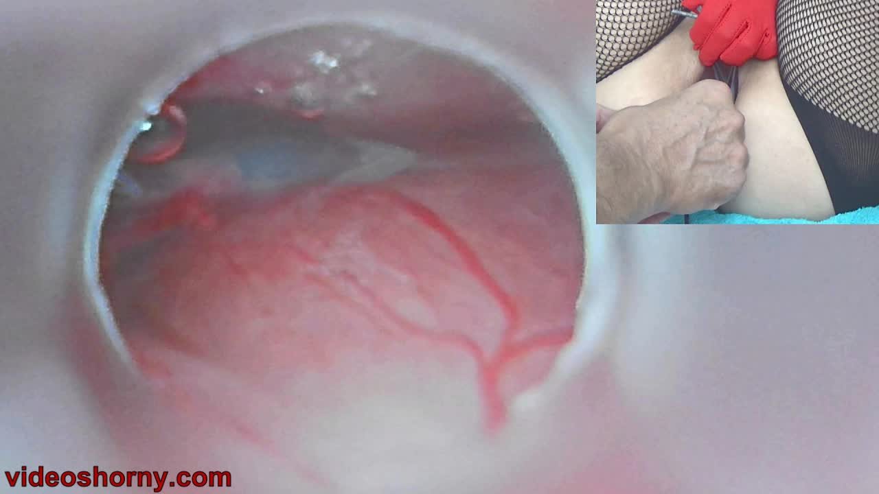 Insemination Cum into Uterus and Endoscope Camera by Cervix